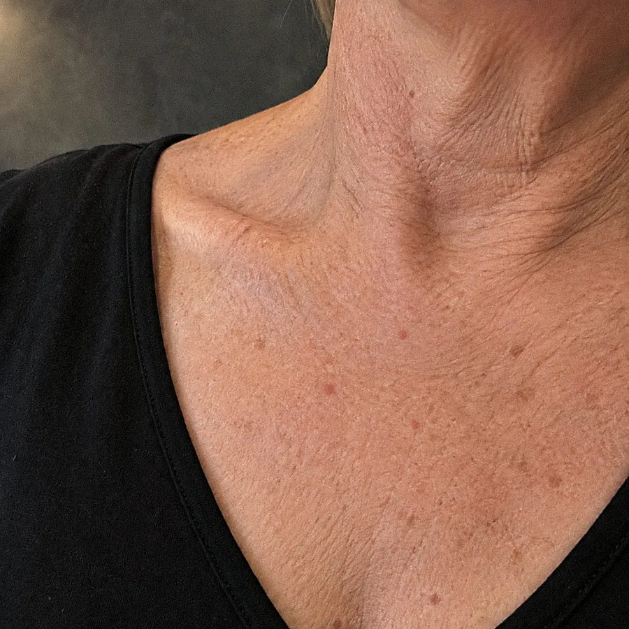 Bloedblaasjes op het decolleté: na de behandeling (voorbeeldbeeld)