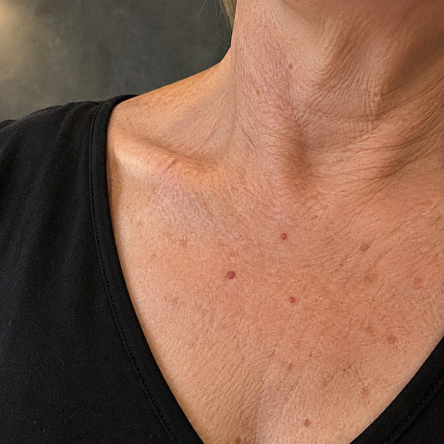 Bloedblaasjes op het decolleté: voor de behandeling (voorbeeldbeeld)