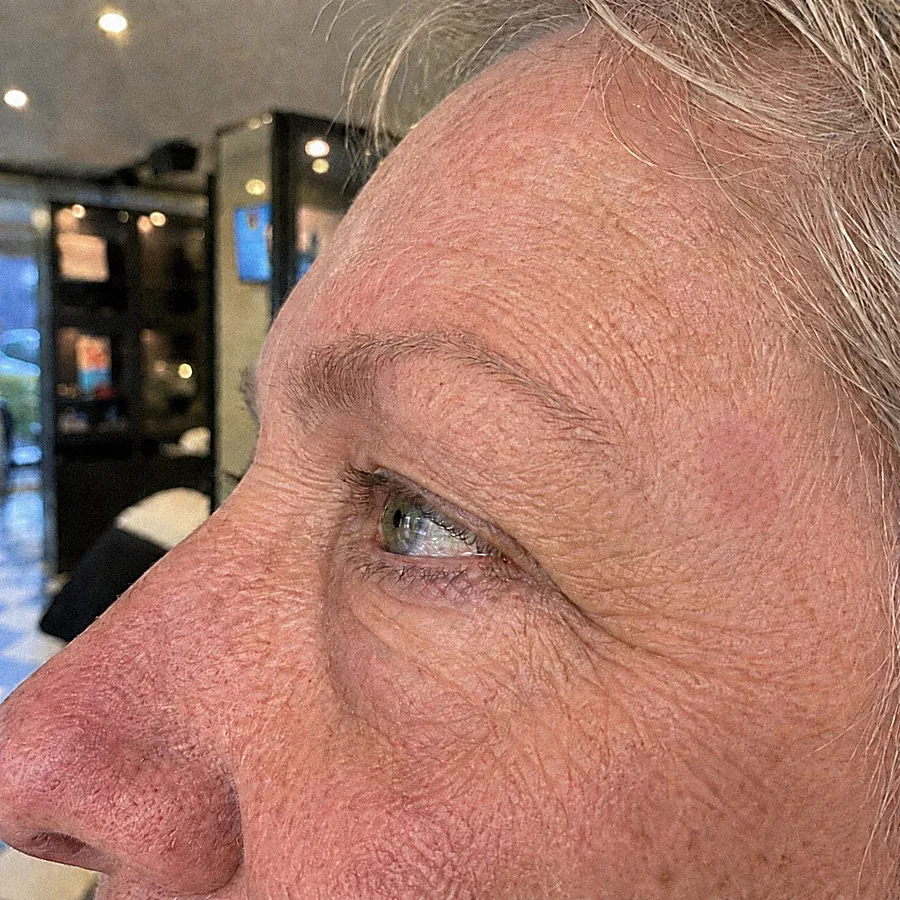 Ouderdomsvlek bij de slaap: na de behandeling (voorbeeldbeeld)