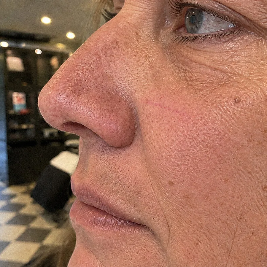 Kleine adertjes op de wang: na de behandeling (voorbeeldbeeld)