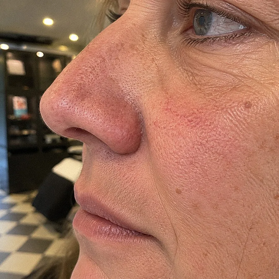 Kleine adertjes op de wang: voor de behandeling (voorbeeldbeeld)